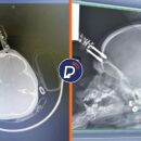 Imagens de raio-x que mostra carregador na testa da menina.