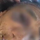 Imagem da idosa de 88 com ferimento na altura do olho direito ap&oacute;s confus&atilde;o dentro de casa.