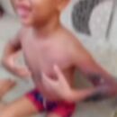 Crian&ccedil;a sofreu queimaduras de segundo e terceiro graus.