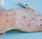 MPOX: primeiro caso do ano &eacute; confirmado no Brasil 