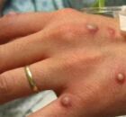 Pessoa infectada com var&iacute;ola dos macacos. 