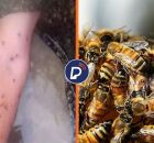 Bra&ccedil;o da v&iacute;tima todo picado e um enxame de abelhas. 