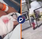 Garoto perde dedo da m&atilde;o ap&oacute;s explos&atilde;o dentro do Sport