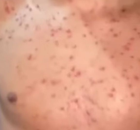 Adolescente de 15 anos com suposto MPOX