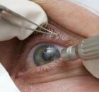 Mudan&ccedil;a na cor dos olhos. 