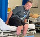 Cirurgi&atilde;o que amputou pr&oacute;prias pernas.