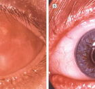 A esquerda coberto com a mucosa avermelhada do interior da boca, e com um pequeno c&iacute;rculo para a passagem da luz, a direita com a pr&oacute;tese para efeitos est&eacute;ticos.