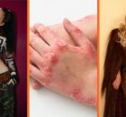 De idol do K-pop a Beyonc&eacute;: saiba qual &eacute; a doen&ccedil;a de pele que j&aacute; afeta milhares de pessoas 