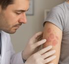 Les&otilde;es de psor&iacute;ase.