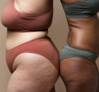 O lipedema resulta no ac&uacute;mulo de gordura, se assemelhando &agrave; celulite. 