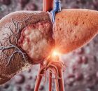 Gordura no f&iacute;gado pode ser revertida em 3 a 6 meses com h&aacute;bitos saud&aacute;veis. 