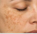 Manchas de melasma podem aparecer com mais intensidade em pessoas com ferritina baixa.