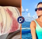 Turista &eacute; mordida por tubar&atilde;o em Fernando de Noronha.