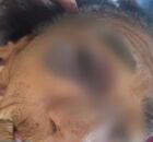 Imagem da idosa de 88 com ferimento na altura do olho direito ap&oacute;s confus&atilde;o dentro de casa.