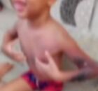 Crian&ccedil;a sofreu queimaduras de segundo e terceiro graus.