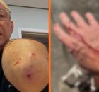 Jos&eacute; Roberto Burnier ap&oacute;s ataque de pitbull.