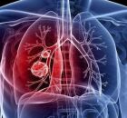 Hipertens&atilde;o pulmonar. 