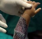 Cear&aacute; ter&aacute; primeira f&aacute;brica em larga escala de curativo feito de pele de til&aacute;pia.
