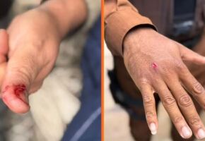 V&iacute;timas mostram ferimentos nas m&atilde;os causados pelo animal.
