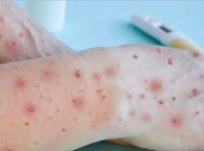 Var&iacute;ola dos Macacos.