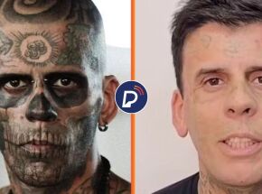 Antes e depois ap&oacute;s homem mais tatuado do Brasil remover marcas.