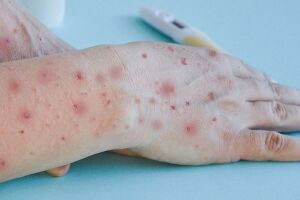 MPOX: primeiro caso do ano &eacute; confirmado no Brasil 