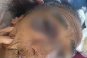 Imagem da idosa de 88 com ferimento na altura do olho direito ap&oacute;s confus&atilde;o dentro de casa.
