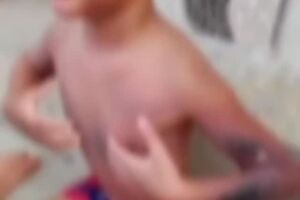 Crian&ccedil;a sofreu queimaduras de segundo e terceiro graus.