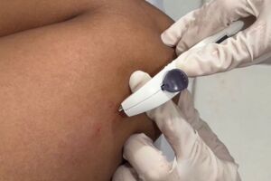 M&eacute;todo contraceptivo Implanon.