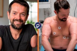 Paciente recebe primeiro transplante duplo de bra&ccedil;o e ombro do mundo ap&oacute;s acidente