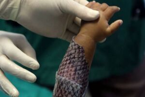 Cear&aacute; ter&aacute; primeira f&aacute;brica em larga escala de curativo feito de pele de til&aacute;pia.