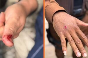 V&iacute;timas mostram ferimentos nas m&atilde;os causados pelo animal.