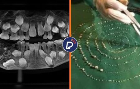Ultrassom da boca do garoto e os dentes retirados.
