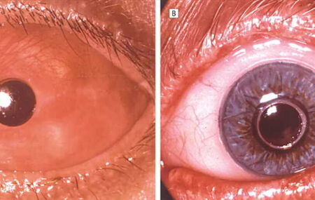 A esquerda coberto com a mucosa avermelhada do interior da boca, e com um pequeno c&iacute;rculo para a passagem da luz, a direita com a pr&oacute;tese para efeitos est&eacute;ticos.