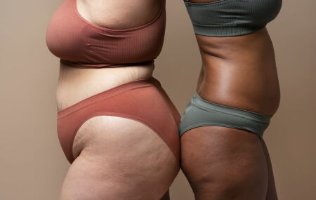 O lipedema resulta no ac&uacute;mulo de gordura, se assemelhando &agrave; celulite. 