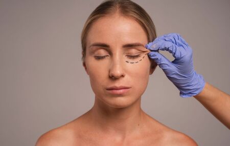 M&eacute;dico realiza marca&ccedil;&atilde;o antes da mini blefaroplastia "baby bleph" em paciente.