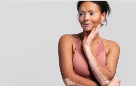 Manchas claras no bra&ccedil;o e rosto de pessoa com vitiligo refletem a visibilidade da condi&ccedil;&atilde;o na pele.