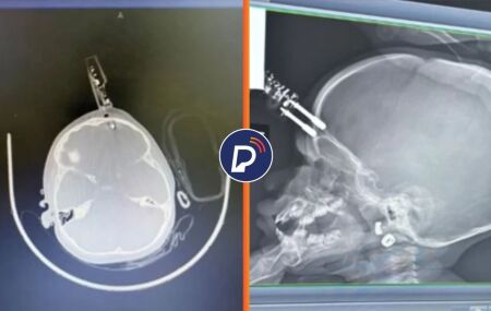 Imagens de raio-x que mostra carregador na testa da menina.