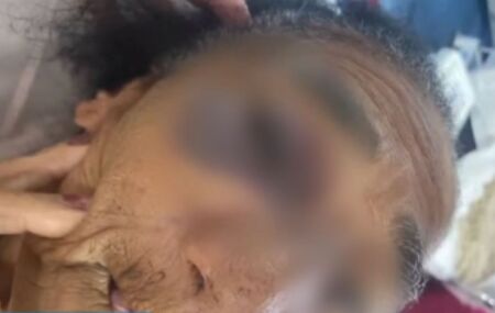 Imagem da idosa de 88 com ferimento na altura do olho direito ap&oacute;s confus&atilde;o dentro de casa.