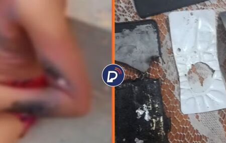 Crian&ccedil;a de 6 anos sofre queimaduras ap&oacute;s explos&atilde;o de celular enquanto carregava aparelho no Recife.
