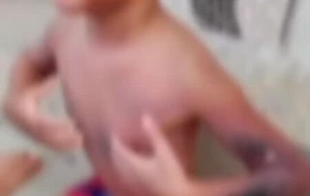 Crian&ccedil;a sofreu queimaduras de segundo e terceiro graus.