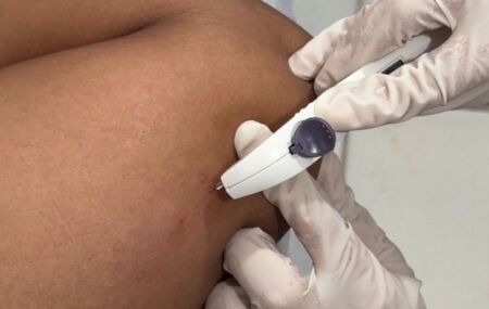 M&eacute;todo contraceptivo Implanon.