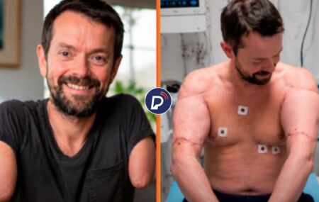 Paciente recebe primeiro transplante duplo de bra&ccedil;o e ombro do mundo ap&oacute;s acidente