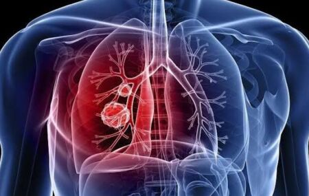 Hipertens&atilde;o pulmonar. 