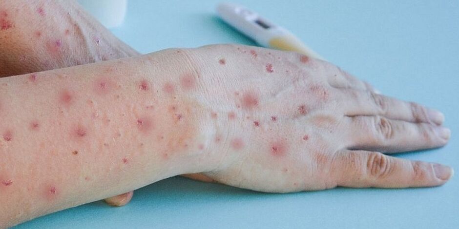 MPOX: primeiro caso do ano &eacute; confirmado no Brasil 